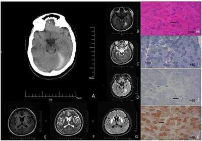 Case report: A unusual case of delayed propionic acidemia complicated with subdural hematoma